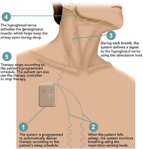 Stimulator nervos implantabil