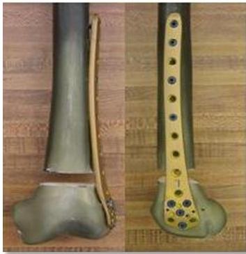 Folosirea LISS în tratarea fracturilor de femur distal şi tibie proximală