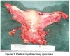 Atitudinea terapeutică în cancerul de col uterin recidivat