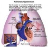 Hipertensiunea pulmonara