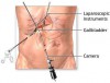 Colecistectomia laparoscopica in tratamentul colelitiazei simptomatice