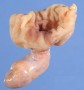 Diverticulul Meckel