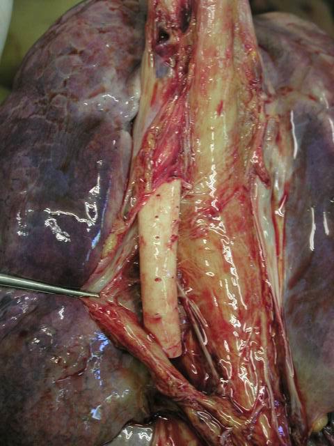 Disecţia porţiunii toracice a aortei