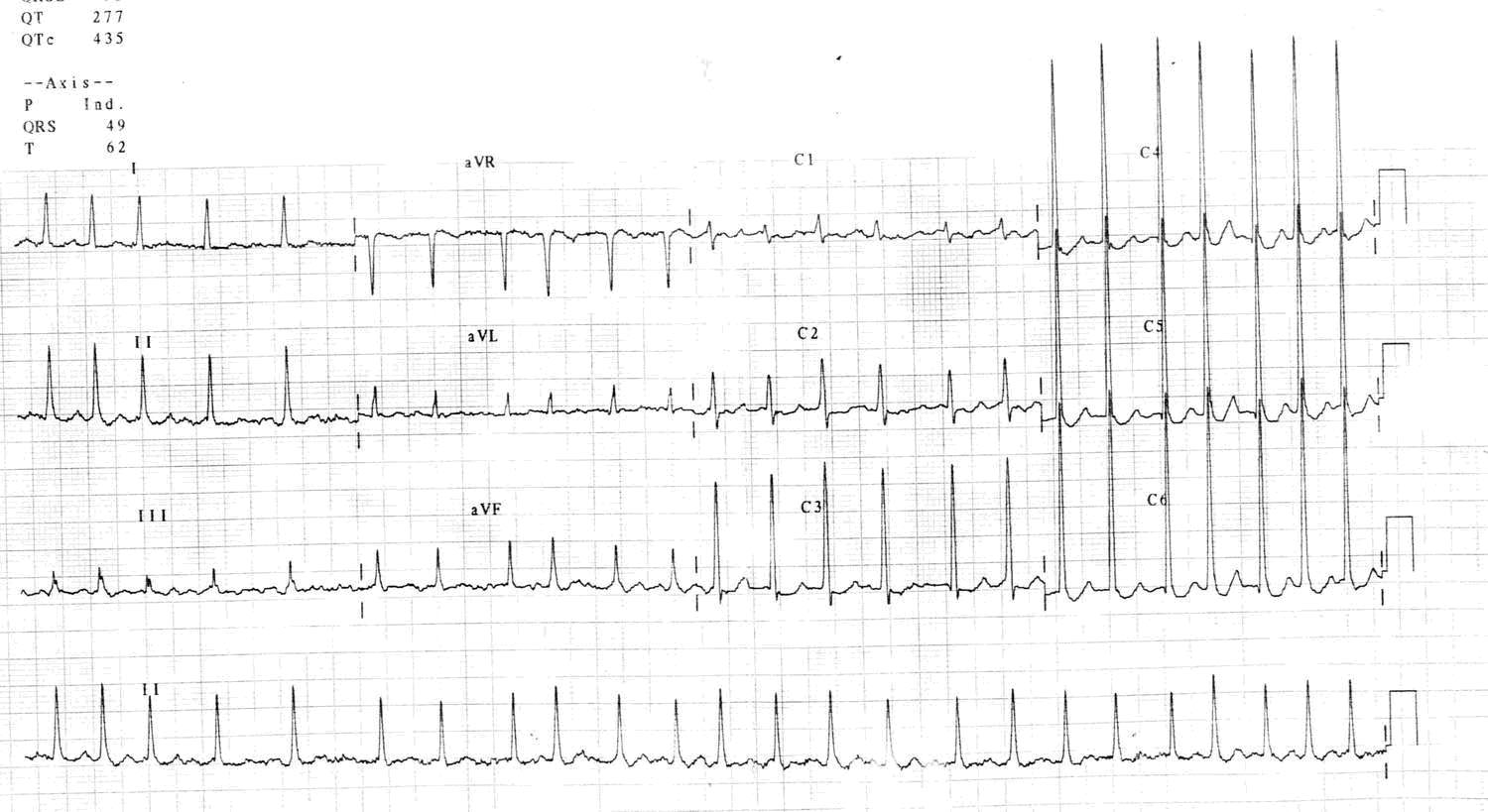 ECG