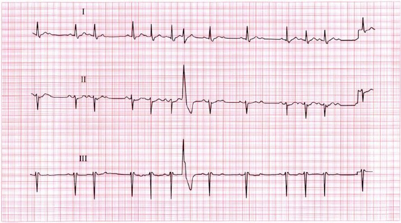 ekg