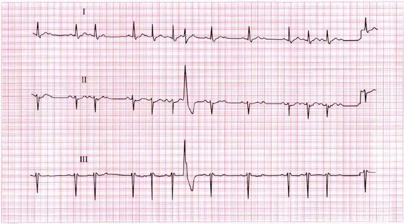 ekg