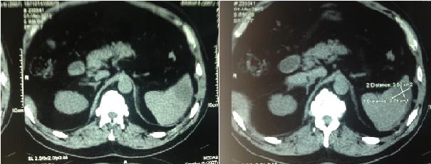 abces splenic