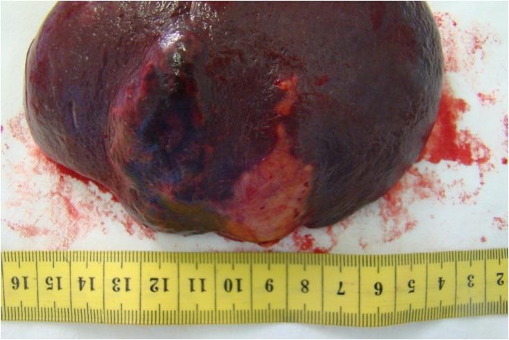 splenectomie