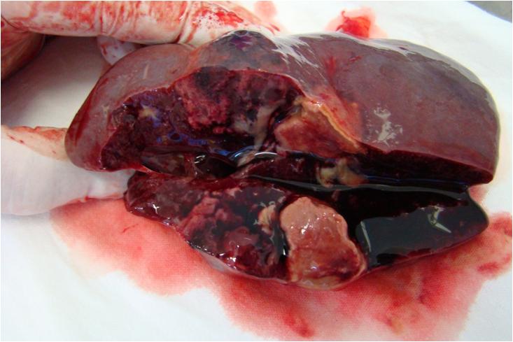 abces splenic