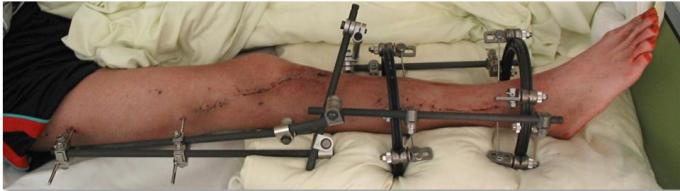Less invasive stabilisation system