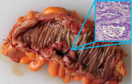 tumora maligna a colonului