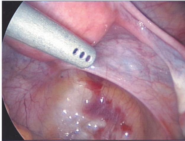 Focar endometriozic la nivelul peritoneului pelvin -aspect intraoperator Focar endometriozic la nivelul peritoneului pelvin -aspect intraoperator