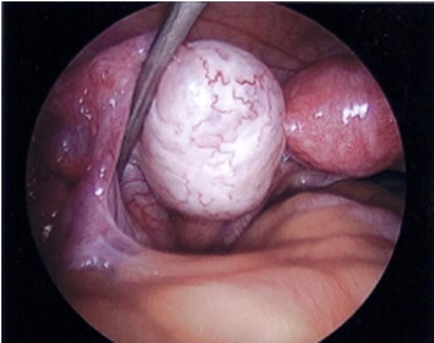 Sindromul Ovarelor polichistice-aspect intraoperator