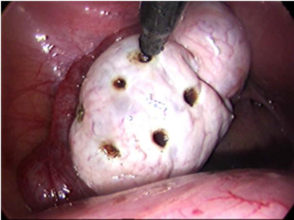 Drilling Ovarian-aspect intraoperator