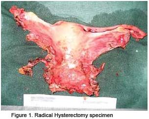 Specimen histerectomie radicala
