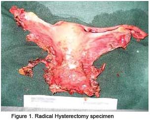 Specimen histerectomie radicala Specimen histerectomie radicala