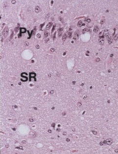 Fig. 3. Alterări neuropatologice ale hipocampului de șobolan inolculat cu prionul scarpiei, HE. Se observă degenerarea spongiformă neuronală, cu vacuole de 10-30µm în diametru. Py – stratul piramidal; SR – stratum radiatum (Prusiner, 1998)