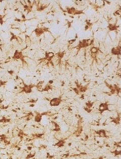 Fig. 1. Imunohistochimia pentru GFAP (Glial fibrillary acidic protein) relevă proliferare astrocitică reactivă (Prusiner, 1998)