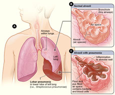 Pneumonia