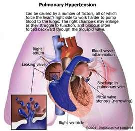 hipertensiunea pulmonara