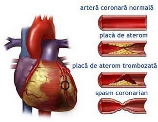 ateroscleroza, spasm coronarian spasm coronarian