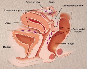 Menstruatia retrograda