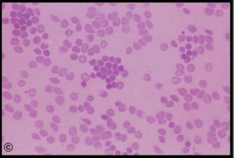 Microsferocite pe frotiul de sange periferic ( După ATLAS OF HAEMATOLOGY, Nivaldo Medeiro, MD, editor ) Microsferocite pe frotiul de sange periferic ( După ATLAS OF HAEMATOLOGY, Nivaldo Medeiro, MD, editor )