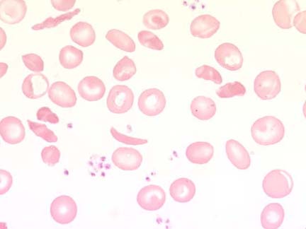 celule sangvine periferice - anemie falciforma