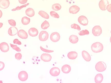 celule sangvine periferice - anemie falciforma