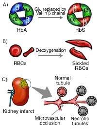 anemia falciforma - fiziopatologie