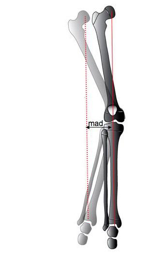 MAD = devierea laterala a axei mecanice a genunchiului, care in mod normal trebuie sa treaca prin centrul patelei.