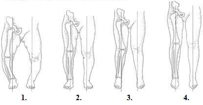 Durerea de genunchi (genunchiul valg) - targulgradinitebucuresti.ro