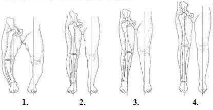 Evolutia fiziologica a alinierii membrului inferior la copil la diferite varste: 1. Nou-nascut=genu varum moderat;  2. 1 an, 6 luni-2 ani=aliniere corecta; 3. 2 ani, 6 luni=genu valgum fiziologic; 4. Intre 4 si 6 ani = aliniere corecta