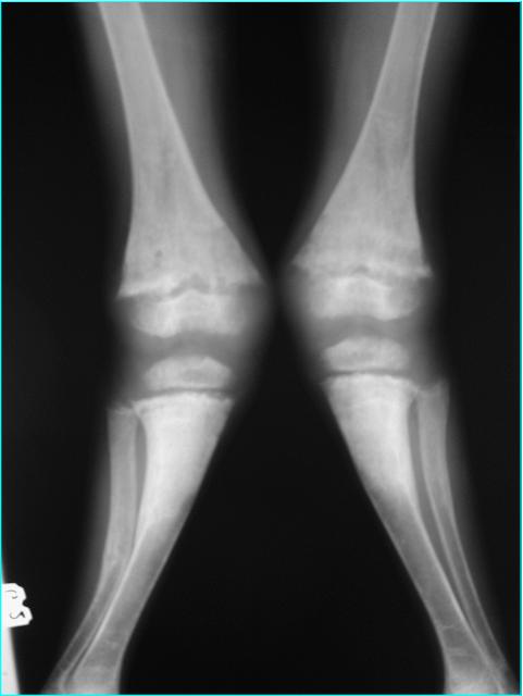 Radiografie a membrelor inferioare din incidenta anteroposterioara : genu valgum bilateral. 