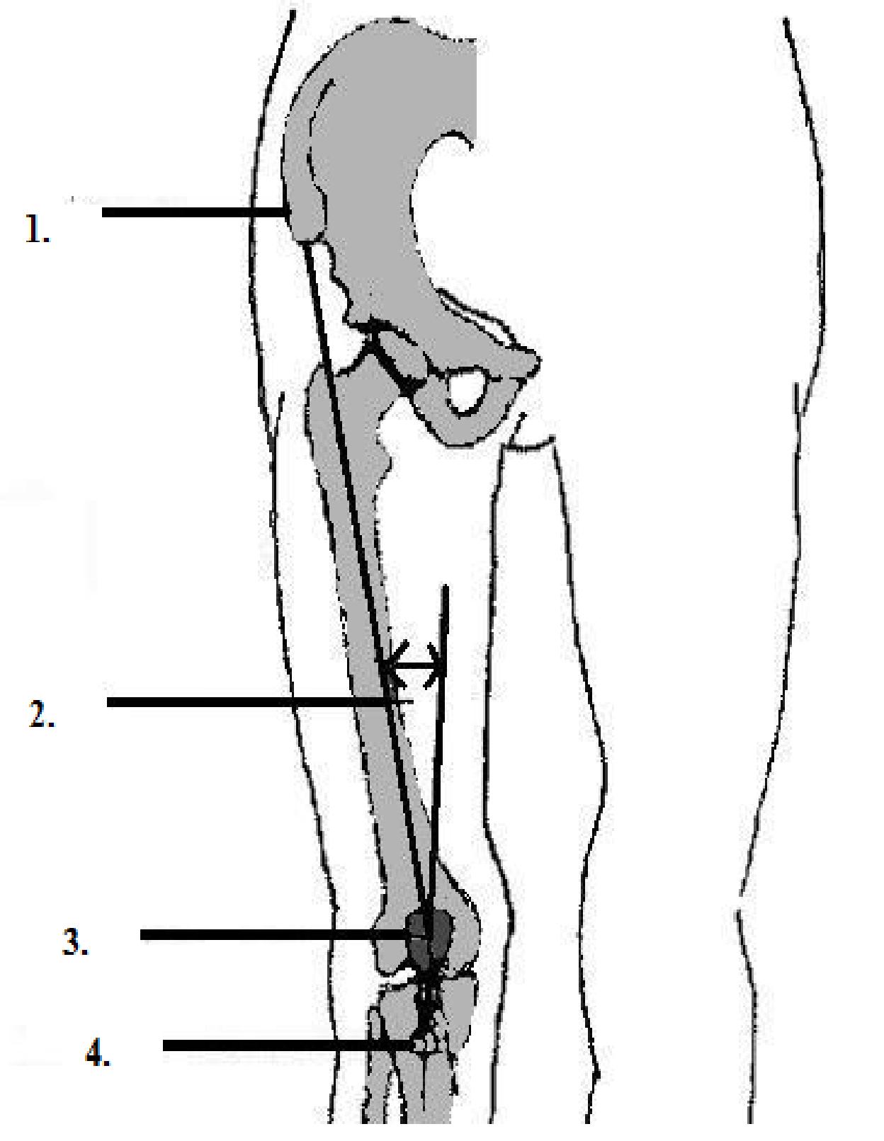 Masurarea unghiului femuro-tibial (unghiul Q): 1. Spina iliaca anterosuperioara; 2. Unghiul tibiofemural; 3. Centrul patelei; 4. Tuberculul tibial