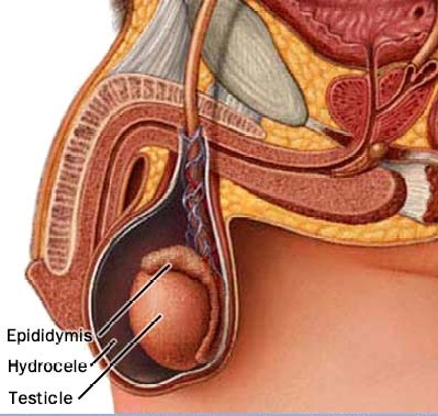 Hidrocelul congenital