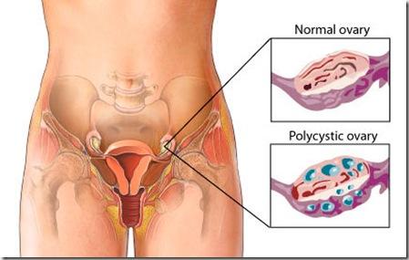 pierdeți în greutate cu ovare polichistice