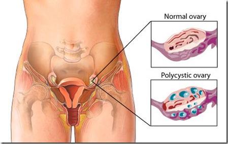 ovar polichistic
