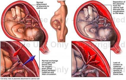 preeclampsia