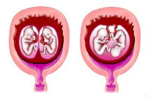 Twin to Twin Syndrome Twin to Twin Syndrome