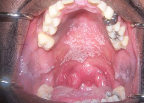Candidoza orala, forma pseudomembranoasa, localizata pe palat