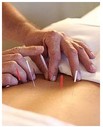 Acupunctura